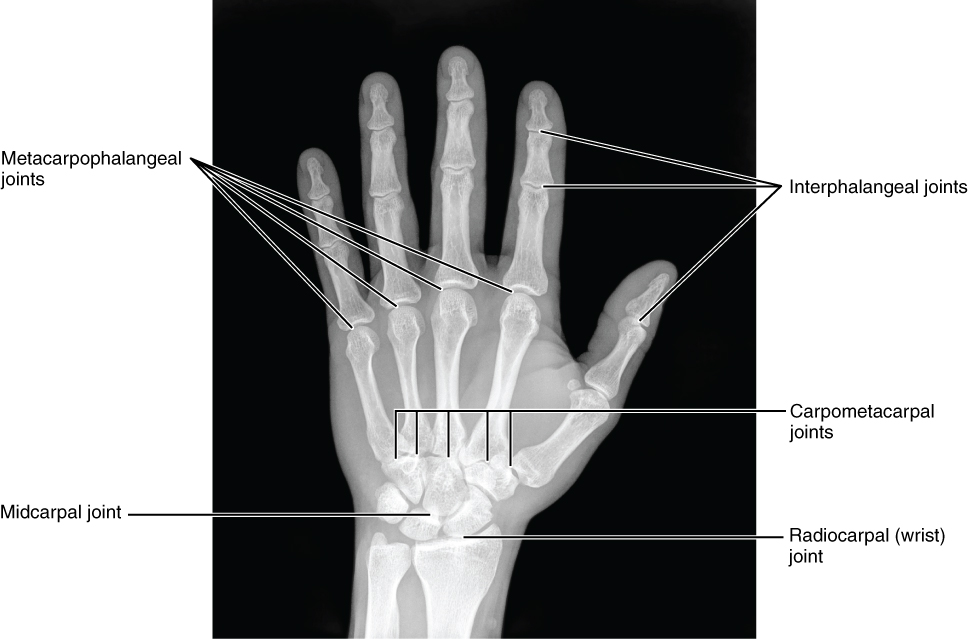 This image shows a radiograph of a human hand.